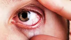 Glaucoma