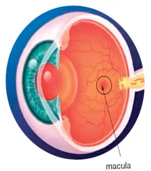 maculopatia