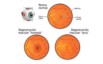 maculopatia